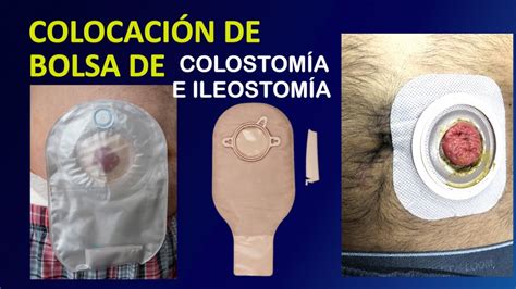 cambio de bolsa colostomía.